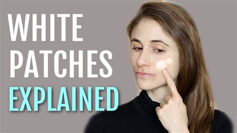White Patches On The Face Explained Pityriasis Alba Dr Dray Youtube