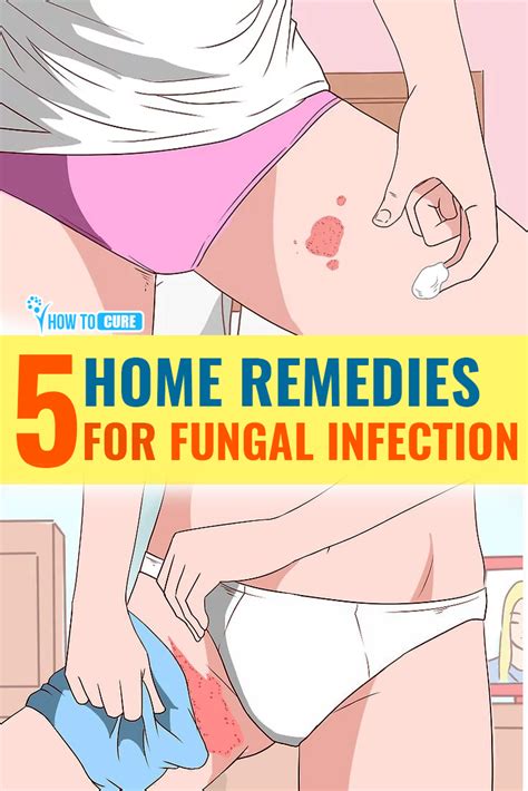 Top 5 Home Remedies For Fungal Infection Howtocure Homeremediesforringworm 5 Proven Home