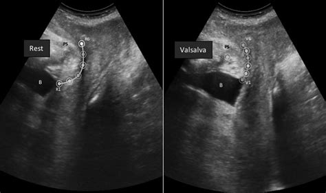 Ics 2022 Abstract 436 The Impact Of Parity On Urethral Motion Profile