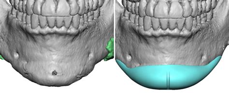 Custom Chin Implant Design After Sliding Genioplasty Front View Dr