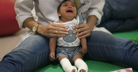 Colombia Reports 32 Cases Of Zika Linked Birth Defects