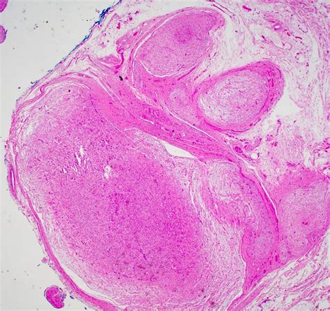 Pathology Outlines Plexiform Neurofibroma