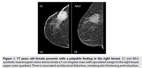 The Utility Of Digital Breast Tomosynthesis In Axillary Lymph Node Post