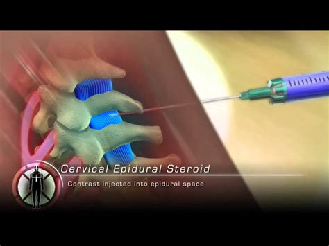 Cervical Epidural Steroid Injection Procedure Animation Youtube