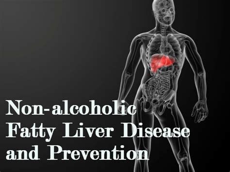 Non Alcoholic Fatty Liver Disease Causes Stages And Prevention