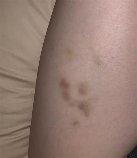 My Story And Picture Of Unexplained Bruising In Details Rparanormal