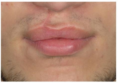 Upper Lip Of Patient No 2 12 Months After Surgery Defect Score 0