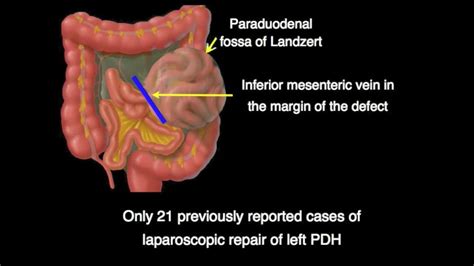 Laparoscopic Repair Of A Left Paraduodenal Hernia Youtube