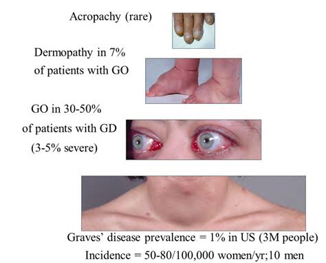 Graves Disease Syndrome A Need For Unified Therapy