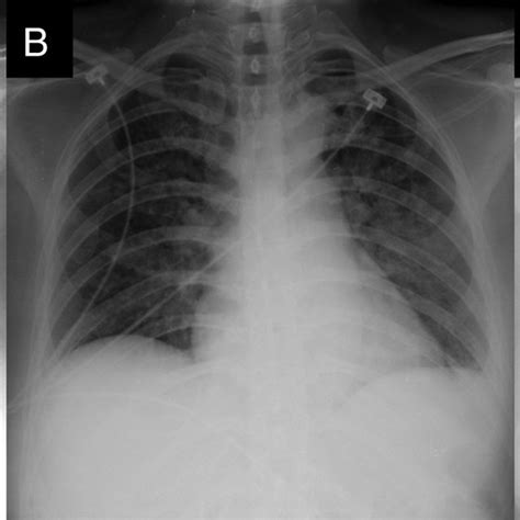 The Serial Chest Radiographs A Breathlessness Onset On Day 1 B