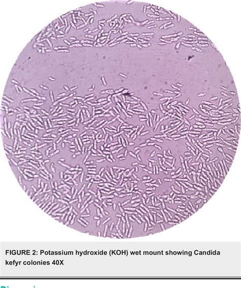 Figure 1 From An Unusual Case Of Candida Kefyr Fungemia In An