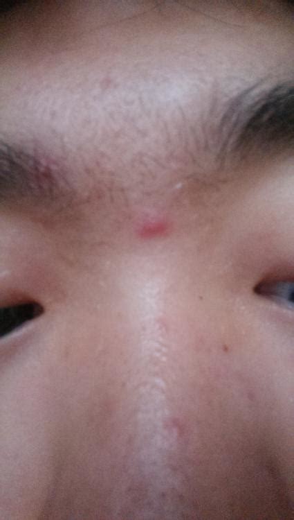 Red Bump Between Eyebrow General Acne Discussion Community