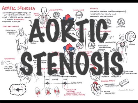 Aortic Stenosis Overview Signs And Symptoms Pathophysiology Treatment Medical News Alley