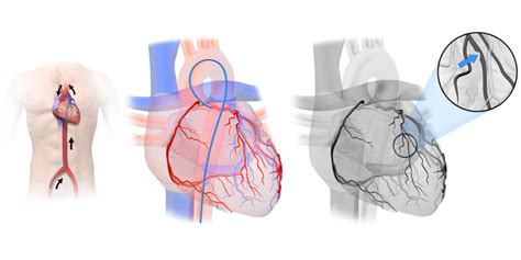 Cardiac Catheterization Diagnosing Heart Disease