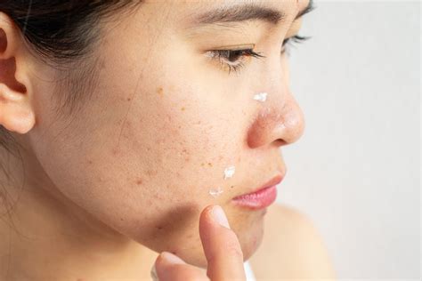 Best Acne Treatments