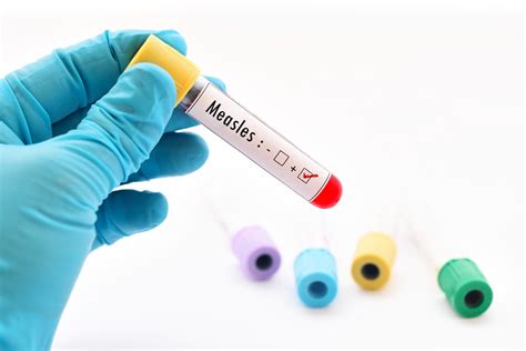 Measles Outbreak Updates Health Beat