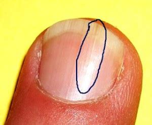 Vertical lines on nails may seem like a cause for concern. What is Onychoschizia? - Nails Journal