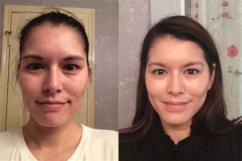 Dermatica Tretinoin 6 Month Results Update Plus How To Manage Sun