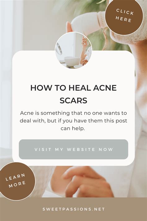 How To Heal Acne Scars Sweet Passions
