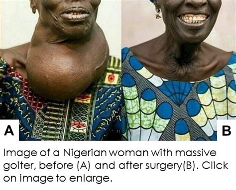 Goiter In Nigeria What You Need To Know