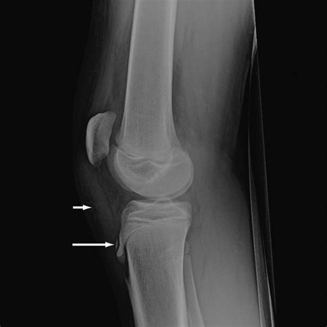 Osgood Schlatter Disease Maher And Ilgen 2013 Bmj Case Reports