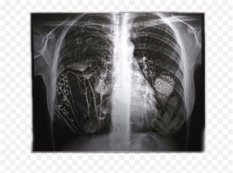 Lungs Xray X Emojix Ray Emoji Free Transparent Emoji