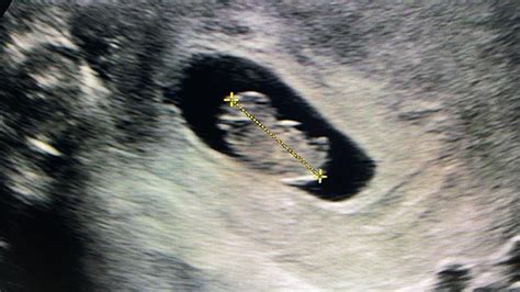 8 12 Weeks Pregnancy Scan International Ultrasound Services