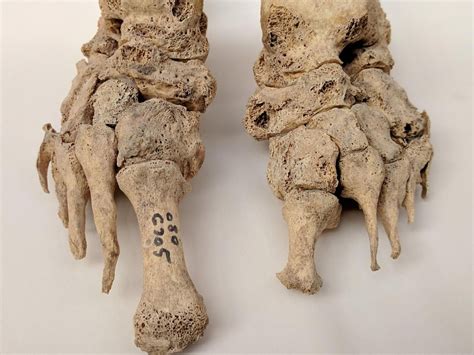 Did leprosy originate in Europe? | UCL News - UCL - London's Global University