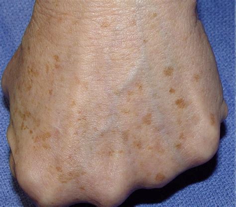 Age Spots On Hands Natural Skin Care Solutions