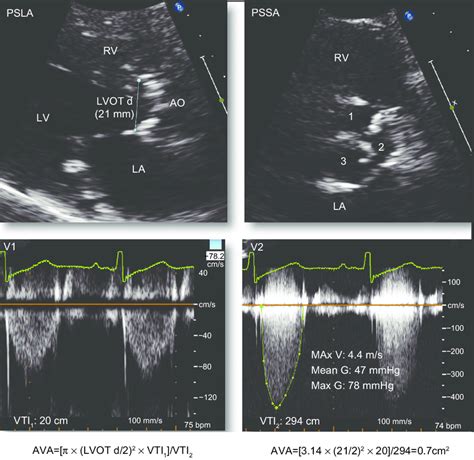 Conventional Echodoppler Measurements In Aortic Stenosis