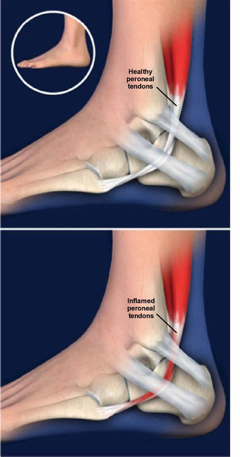 Peroneal Tendonitis Causes Symptoms And Treatment Options Hot Sex Picture
