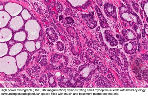 Severe epithelial atypia and loss of polarity are present with an intact basement membrane and histologic findings of noninvasive carcinoma. Pathology Outlines - Adenoid cystic carcinoma