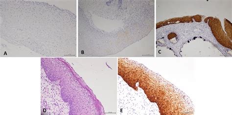 A P16 Immunohistochemical Staining Showed Negative B P16