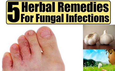 Top 5 Herbal Remedies For Fungal Infections Natural Home Remedies