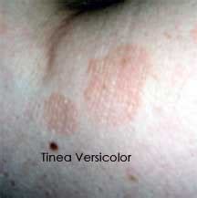 Tinea versicolor is a fairly common disease. Black Spots on Skin, Face and Body Causes and Treatment