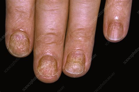 Psoriasis Of The Fingernails Stock Image C0510056 Science Photo