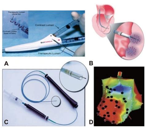 Devices Of Transendocardial Injection A The Helical Needle Catheter