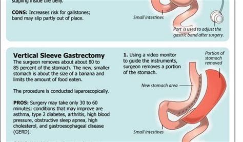Infographic Types Of Weight Loss Surgery Types Of I