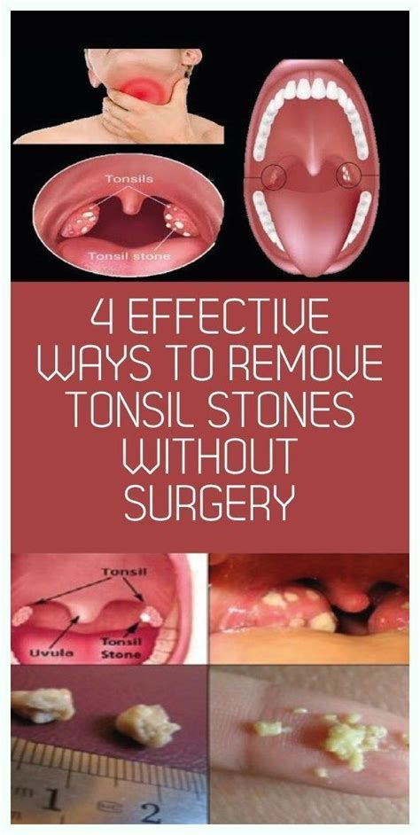 How To Prevent Tonsil Stones Easy Effective Artofit