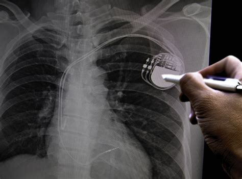An implanted device that contains batteries. Permanent Pacemaker Interrogation - Cos Cardio