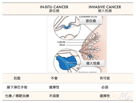 Dcis Vs Idc Breast Cancer Hk 香港的乳癌治療資訊