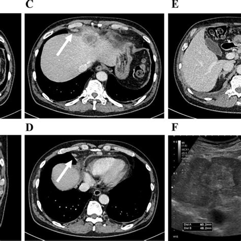 Abdominal Contrast Enhanced Computed Tomography And Ultrasonography On