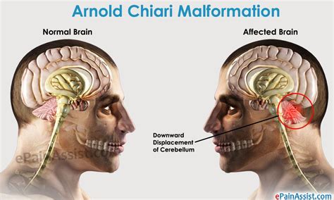 Arnold Chiari Malformation Read Brainarnold Chiari Malformation