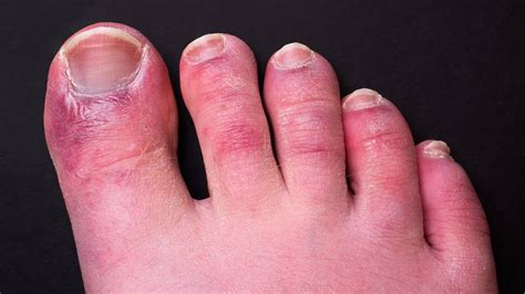 Check Your Feet Covid Toes Are A New And More Rampant Sign Of