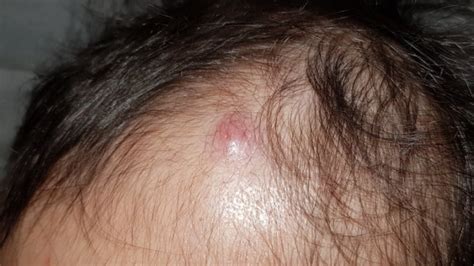 Lump On Back Of Baby S Head Near Neck Get More Anythinks
