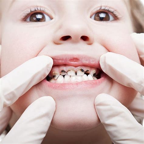 Plaque And Tooth Decay Treatment Hampton Siana Dental