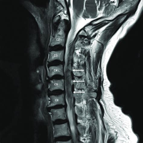 Sagittal Magnetic Resonance Image Of The Cervical Spine T2 Weighted