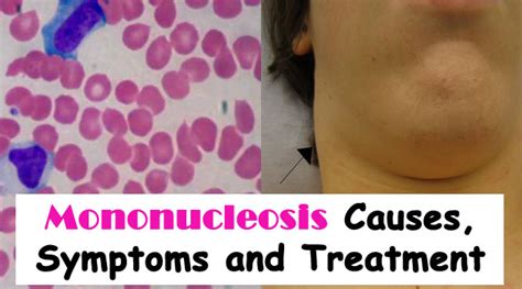 Mononucleosis Causes Symptoms And Treatment