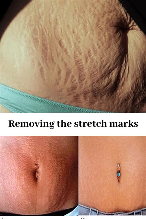 Use The Trilastin Stretch Marks Creams Range For Fast Removing Stretch