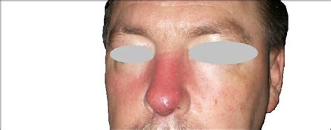 Nasal Cellulitis Causes Symptoms And Treatments